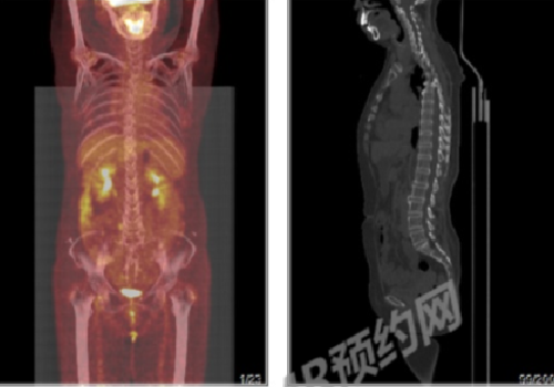 肺部结节，做PETCT检查案例-全国PETCT/MR检查预约网-癌症筛查-肿瘤复查-高端体检