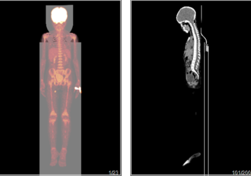 淋巴瘤治疗后复查，做PETCT检查-全国PETCT/MR检查预约网-癌症筛查-肿瘤复查-高端体检