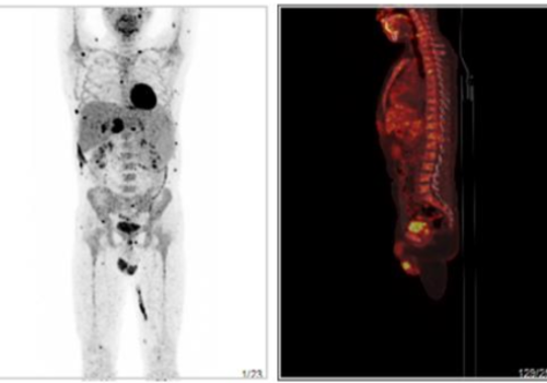 淋巴瘤治疗后复查，做PETCT检查案例-全国PETCT/MR检查预约网-癌症筛查-肿瘤复查-高端体检